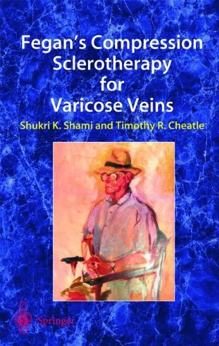 Fegan's Compression Sclerotherapy for Varicose Veins