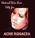 Rosacea - Natural Skin Care Help for Acne Rosacea