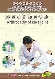 Osteoarthrosis of Knee Joint