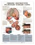 Chronic Obstructive Pulmonary Disease (COPD) Anatomical Chart Unmounted