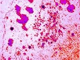 Herpes Encephalitis Inflammation Brain Photographic Poster Print, 40x30