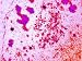 Herpes Encephalitis Inflammation Brain Photographic Poster Print, 16x12