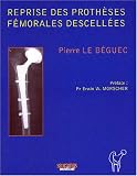 Reprise des proth�ses f�morales descell�es