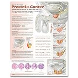 Understanding Prostate Cancer Anatomical Chart