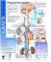 Hypertension: Gray's Anatomy Poster Series, 1e