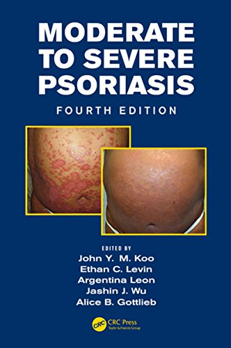 Moderate to Severe Psoriasis, Fourth Edition