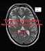 "I've been lucky really...." - My experience of surviving a stroke.