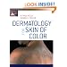 Dermatology for Skin of Color