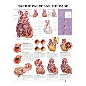 Click here to buy Chart - Cardiovascular Disease by Lake Forest Anatomicals Hearts.