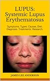 LUPUS: Systemic Lupus Erythematosus: Symptoms. Types. Causes. Diet. Diagnosis. Treatments. Research. LUPUS: Systemic Lupus Erythematosus: Symptoms. Types. Causes. Diet. Diagnosis. Treatments. Research.