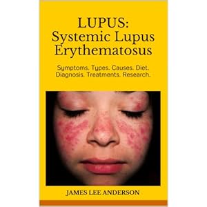 LUPUS: Systemic Lupus Erythematosus: Symptoms. Types. Causes. Diet. Diagnosis. Treatments. Research.