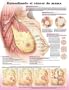 Understanding Breast Cancer Chart (Spanish - Entendiendo el cancer de mama) - Laminated
