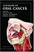 Oral Cancer