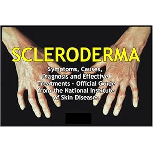 SCLERODERMA: Symptoms, Causes, Diagnosis and Effective Treatments - Official Guide from the National Institute of Skin Diseases