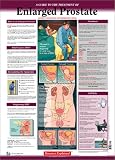Diseases Explained: Enlarged Prostate Wall Chart