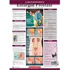 Diseases Explained: Enlarged Prostate Wall Chart by Lexi-Comp