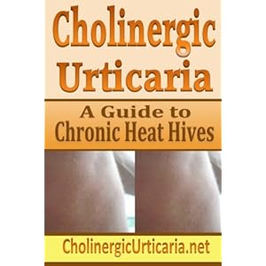 Cholinergic Urticaria: A Guide to Chronic Heat Hives