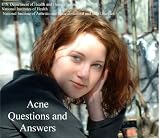 Acne Causes, Symptoms, Signs, Diagnosis and Treatments