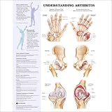Understanding Arthritis Anatomical Chart