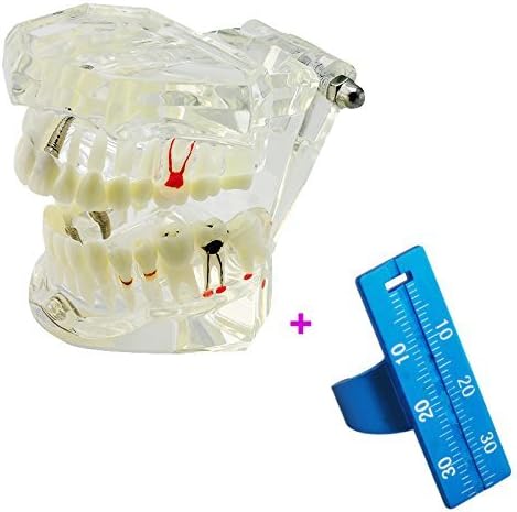 LoMix Dental Implant Disease Teeth Model Study Teaching Teeth Model Adult Typodont Model Removable Tooth