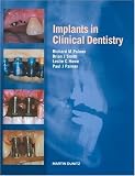 Implants in Clinical Dentistry