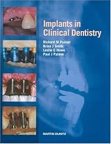 Implants in Clinical Dentistry