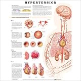 Hypertension Anatomical Chart
