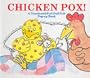 Chicken Pox Hb
