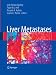 Liver Metastases