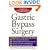 Gastric Bypass Surgery: Everything You Need to Know to Make an Informed Decision