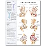 Understanding Arthritis Anatomical Chart in Spanish (Entendiendo la artritis)