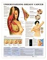 Understanding Breast Cancer Anatomical Chart Plastic Styrene