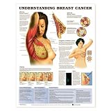 Understanding Breast Disease Poster