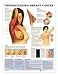 Understanding Breast Cancer Anatomical Chart Plastic Styrene