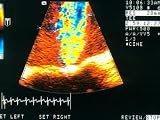 Color Transesophageal Echo Mitral Regurgitation Photographic Poster Print, 32x24
