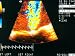 Color Transesophageal Echo Mitral Regurgitation Photographic Poster Print, 16x12