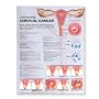 Understanding Cervical Cancer Anatomical Chart