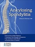 Ankylosing spondylitis