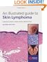 An Illustrated Guide to Skin Lymphoma