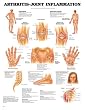 `Understanding Arthritis Chart 20"X 26"h