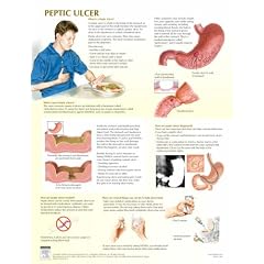 Peptic Ulcer Chart (Netter Charts)