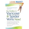 Say Goodbye to Varicose & Spider Veins Now!