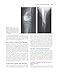Rockwood and Green's Fractures in Adults + Rockwood and Wilkin's Fractures in Children