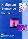 Malignant Tumors of the Skin