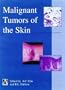 Malignant Tumors of the Skin