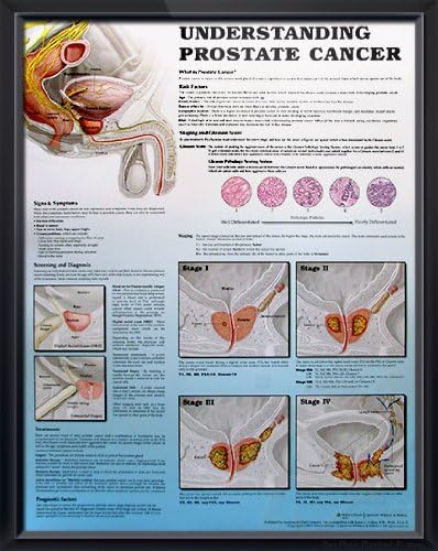Understanding Prostate Cancer, 2E, DeuPair 20x26" Pocket Frame Human Anatomy Poster