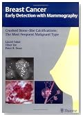 Breast Cancer: Early Detection with Mammography: Crushed Stone-like Calcifications: The Most Frequent Malignant Type