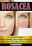 Rosacea: An Essential Guide to Understanding What Causes Rosacea and How to Get Rid of It For Good