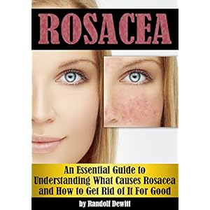 Rosacea: An Essential Guide to Understanding What Causes Rosacea and How to Get Rid of It For Good