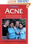 Acne: The 'At Your Fingertips' Guide